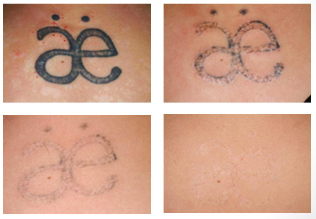 Cheap Tattoo Removal Machine Q Switch ND Yag Laser Device New India Works  at best price in Mumbai
